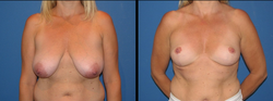 Paul E. Chasan MD - breast reduction patient